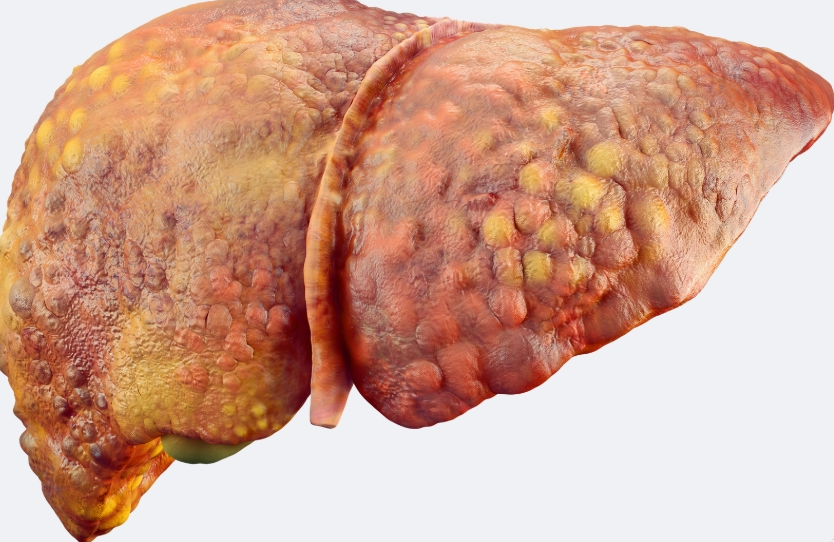 Understanding-Fatty-Liver-Disease-A-Silent-Threat-to-Your-Health selfloveclub