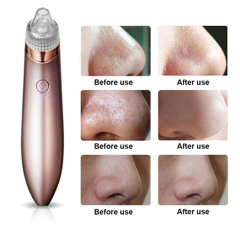 Electric Blackhead Vacuum Pore Cleaner SELFLOVECLUB