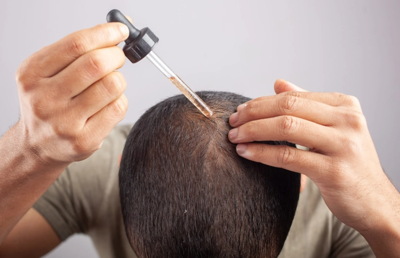 Hair-Loss-Understanding-Causes-Prevention-and-Treatments selfloveclub