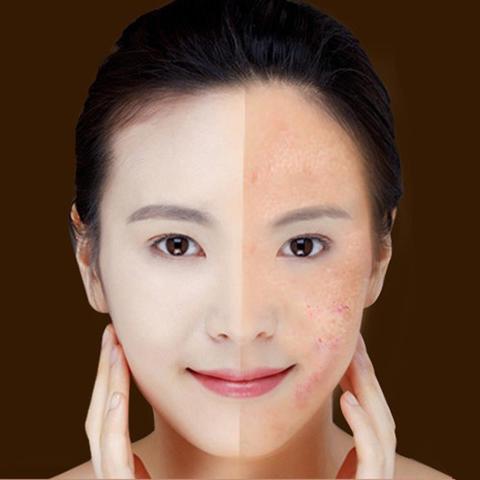 Blue Light Therapy Acne Laser Pen Soft Scar Wrinkle Removal Treatment Device Skin Care Beauty Equipment SELFLOVECLUB